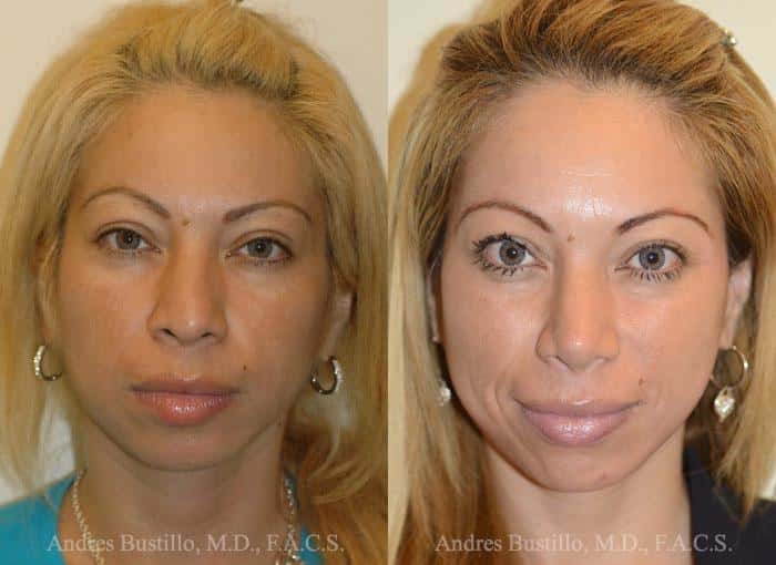 dremafiller-before-and-after